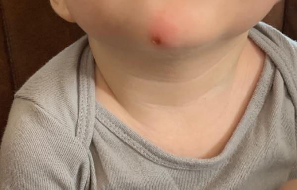 Bild zu Ist das ein stich? - Baby Forum - Allgemeine Themen