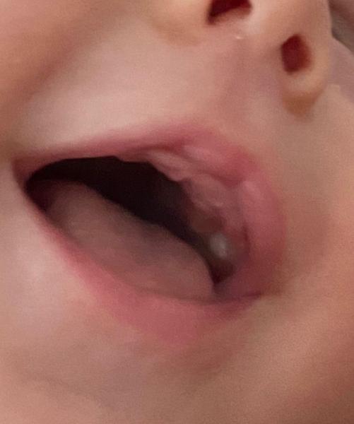 Bild zu Backenzahn mit drei Monaten? - Baby Forum - Allgemeine Themen