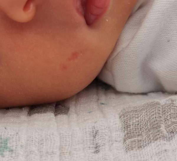 Bild zu Rote Flecken - Baby Forum - Allgemeine Themen