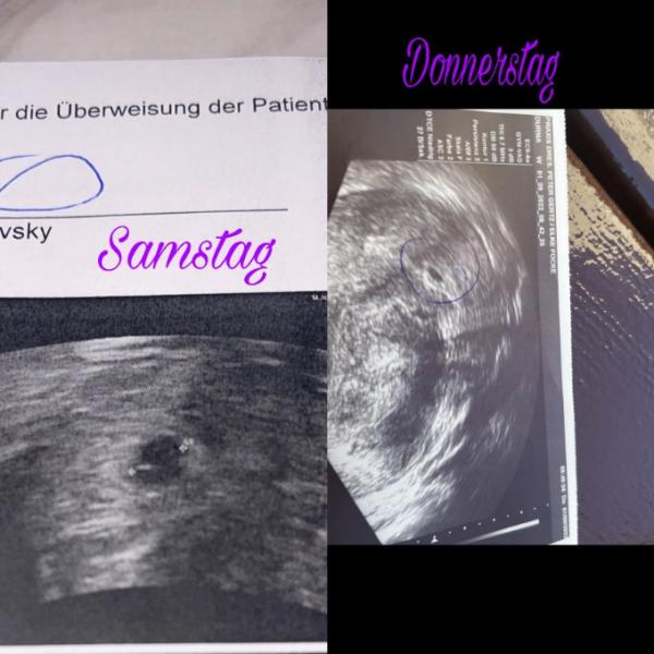 Bild zu Ssw 6+1 Fehlgeburt ? - Baby Forum - Allgemeine Themen