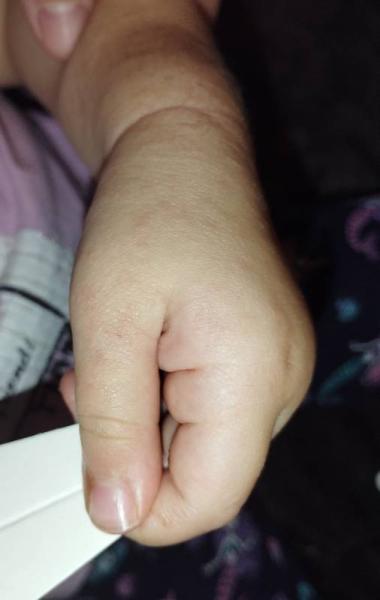 Bild zu Ausschlag Kind 2 J. - Baby Forum - Allgemeine Themen
