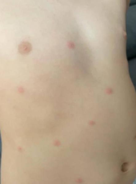 Bild zu Sind das Windpocken? - Baby Forum - Allgemeine Themen