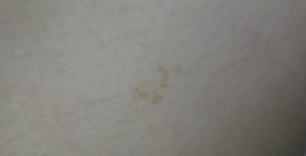 Bild zu Pigmentflecken?? - Baby Forum - Allgemeine Themen