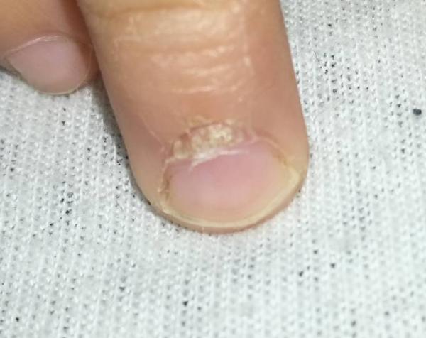 Bild zu Nagelbett sieht komisch aus - Baby Forum - Allgemeine Themen