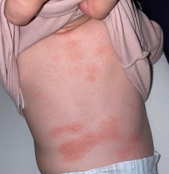 Bild zu Hautausschlag Baby Bauch,Rücken,Hals - Baby Forum - Allgemeine Themen