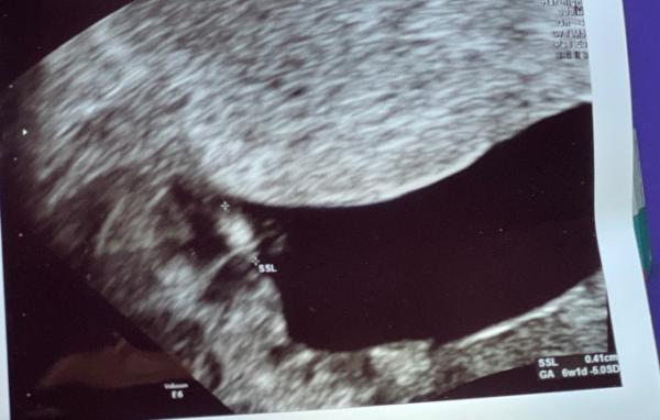 Bild zu Schatten Embryo - Baby Forum - Allgemeine Themen