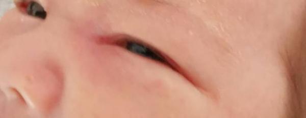 Bild zu Verstopfter Tränenkanal - Baby Forum - Allgemeine Themen
