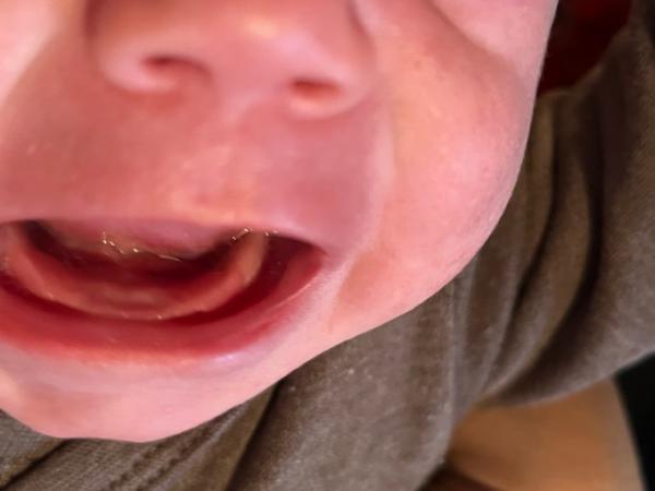 Bild zu Wie lange bis der Zahn drausen ist? - Baby Forum - Allgemeine Themen