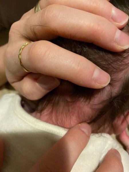 Bild zu Ausschlag im Nacken/Hinterkopf - Baby Forum - Allgemeine Themen