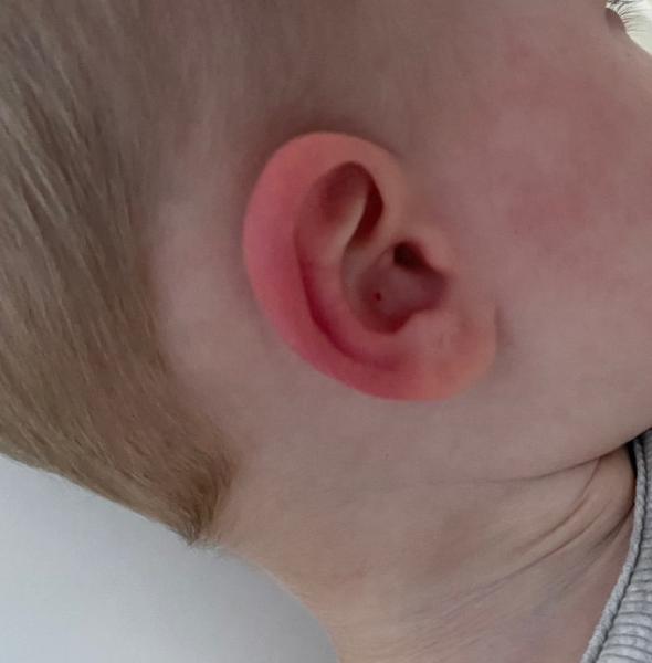 Bild zu Rote Ohrmuschel - Baby Forum - Allgemeine Themen