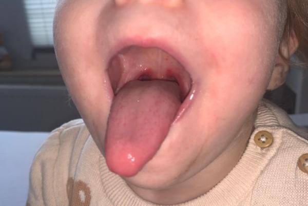 Bild zu Scharlach oder Hand-Fuß-Mund? - Baby Forum - Allgemeine Themen