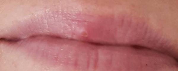 Bild zu Herpes - Baby Forum - Allgemeine Themen
