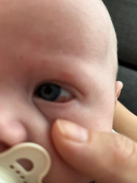 Bild zu roter Fleck im Auge - Baby Forum - Allgemeine Themen