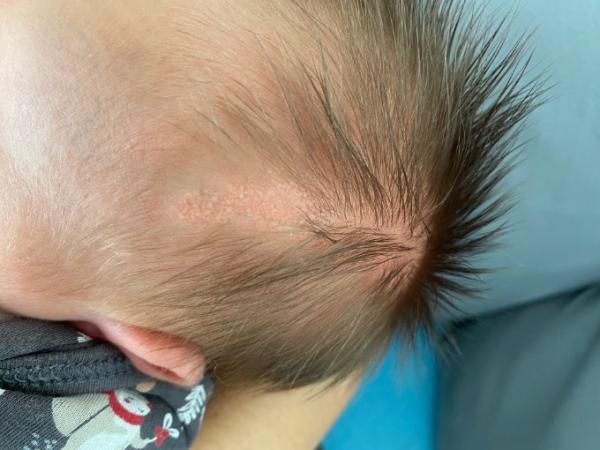 Bild zu Baby mit einer Art Narbe am Kopf geboren - Baby Forum - Allgemeine Themen