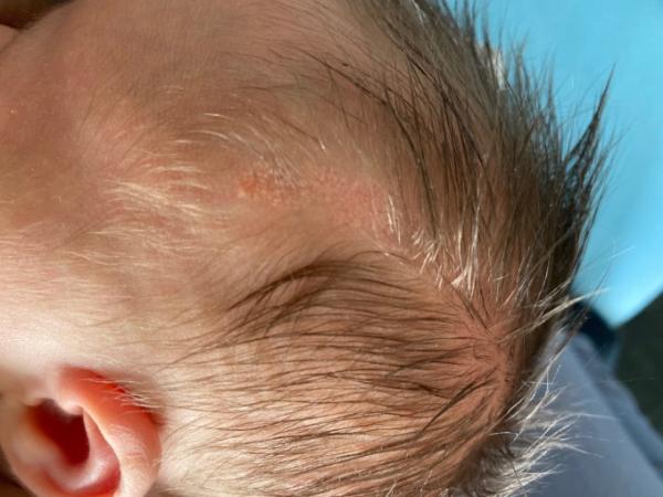 Bild zu Naevi Sebacei/Sebaceus Erfahrungen - Baby Forum - Allgemeine Themen