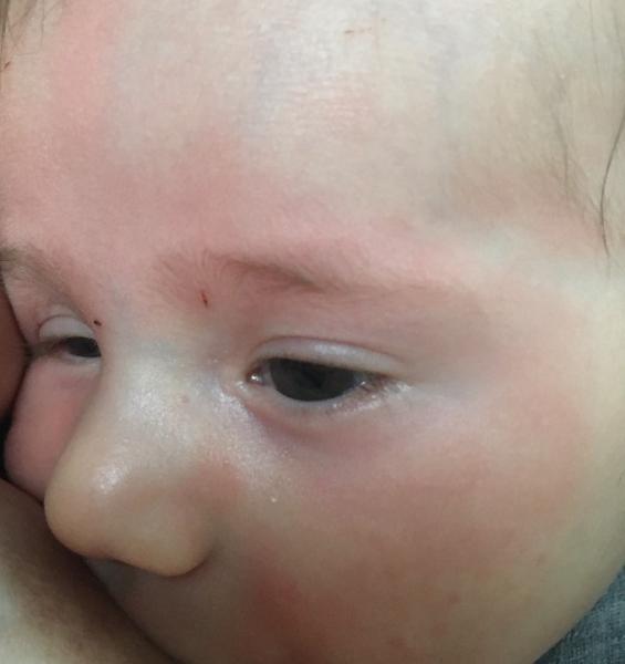 Bild zu Rote Flecken beim Stillen - Baby Forum - Allgemeine Themen