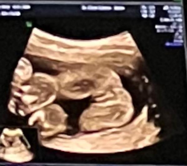Bild zu Welches Geschlecht ist mein Kind ? - Baby Forum - Allgemeine Themen