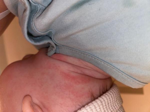 Bild zu Ausgeschlag am Hals - Baby Forum - Allgemeine Themen