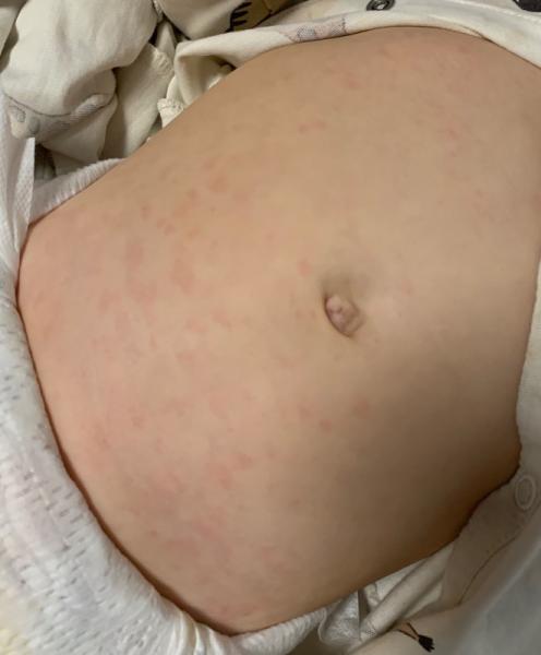 Bild zu Ausschlag? - Baby Forum - Allgemeine Themen