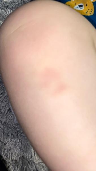 Bild zu Was sind das für Flecken am Bein? 😧 - Baby Forum - Allgemeine Themen