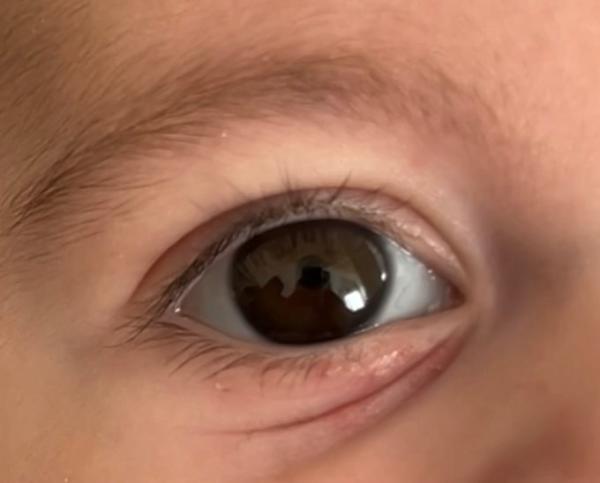 Bild zu Rote Pünktchen unter dem rechten Auge - Baby Forum - Allgemeine Themen