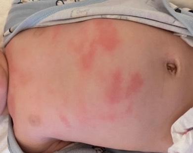 Bild zu Flecken auf der haut - Baby Forum - Allgemeine Themen