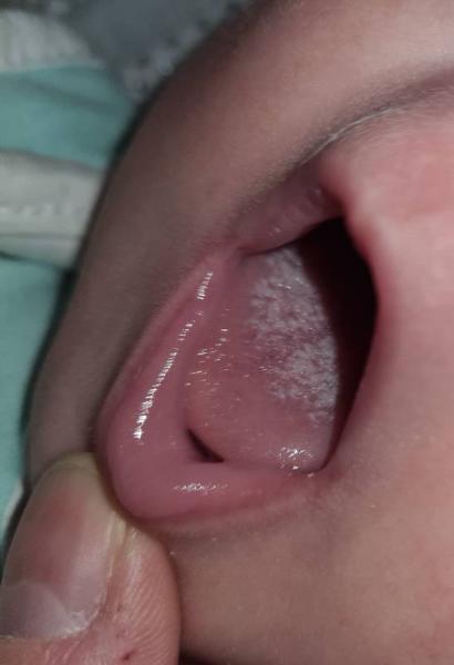 Bild zu Mundsoor?? - Baby Forum - Allgemeine Themen