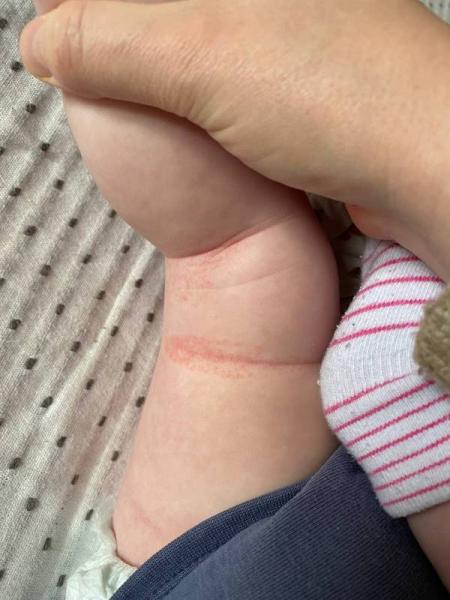 Bild zu Ausschlag in Speckfalten - Baby Forum - Allgemeine Themen