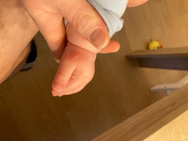 Bild zu Pusteln kommen und verschwinden nach ein paar Minuten - Baby Forum - Allgemeine Themen