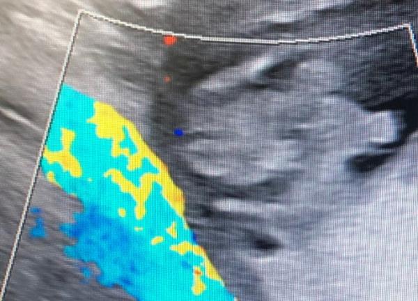 Bild zu Mädchen oder Junge SSW16??? - Baby Forum - Allgemeine Themen