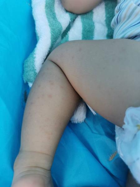 Bild zu Im Urlaub rote Punkte auf der Haut. Hilfe - Baby Forum - Allgemeine Themen