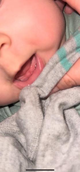 Bild zu Zahnfleisch geschwollen, erste Zähne was sagt ihr - Baby Forum - Allgemeine Themen