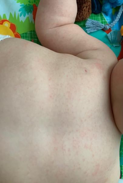 Bild zu Ausschlag Baby nach Krankheit - sorgen - Baby Forum - Allgemeine Themen