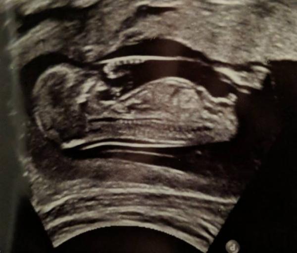Bild zu Kann man das Geschlecht sehen? - Baby Forum - Allgemeine Themen