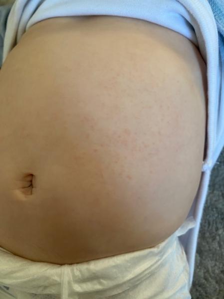 Bild zu Petechien - Baby Forum - Allgemeine Themen