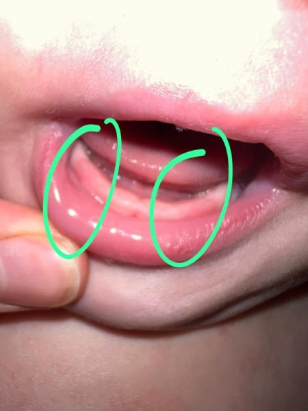 Bild zu Können das die Zähne sein?! 🦷 (mit Foto) - Baby Forum - Allgemeine Themen