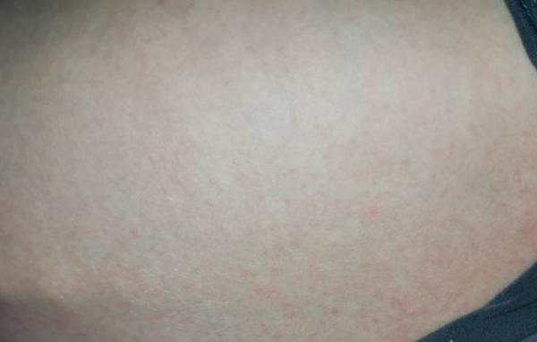 Bild zu Ausschlag- jemand eine Idee? - Baby Forum - Allgemeine Themen