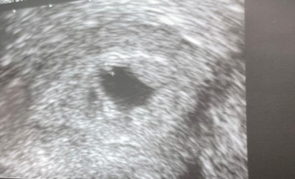 Bild zu 6 SSW ?! - Baby Forum - Allgemeine Themen