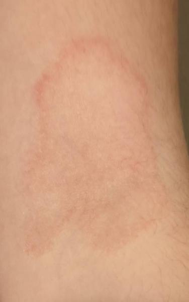 Bild zu Haut an der Armbeuge, was könnte das sein? - Baby Forum - Allgemeine Themen