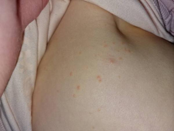 Bild zu Hilfeee Ausschlag Krankheit? - Baby Forum - Allgemeine Themen
