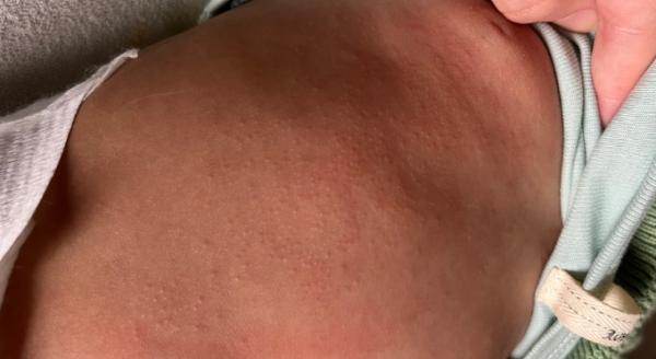 Bild zu Hilfe! hitzepickel? - Baby Forum - Allgemeine Themen