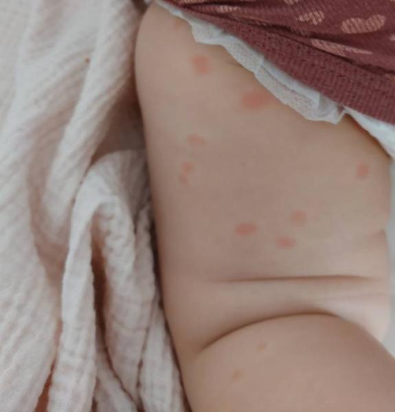 Bild zu Ausschlag an Beinen - Baby Forum - Allgemeine Themen