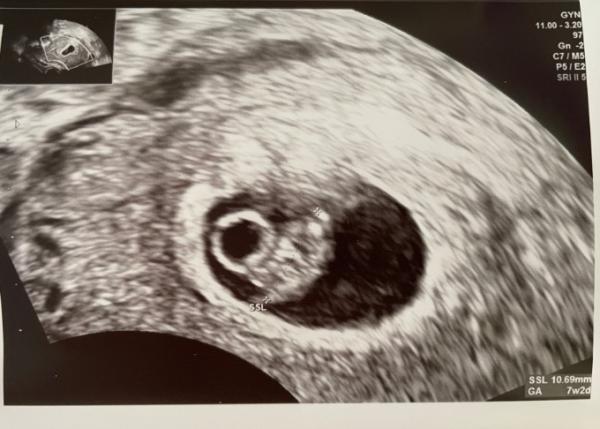 Bild zu Dottersack zu groß / Nackenfalte auffällig - Baby Forum - Allgemeine Themen