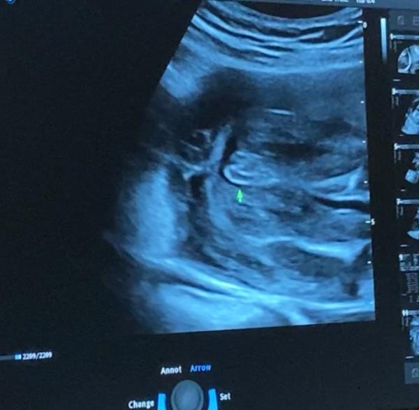 Bild zu Mädchen oder Junge? - Baby Forum - Allgemeine Themen