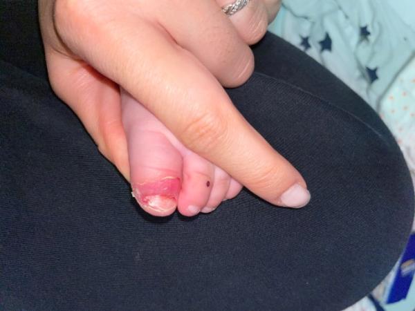 Bild zu Rot/blutiger Zehennagel - Baby Forum - Allgemeine Themen