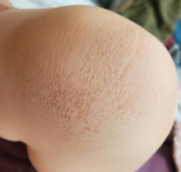 Bild zu Raue Knie - Baby Forum - Allgemeine Themen