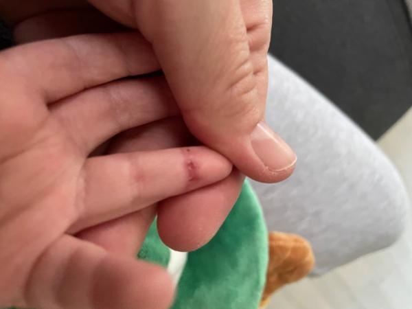 Bild zu Fingerverletzung - Baby Forum - Allgemeine Themen