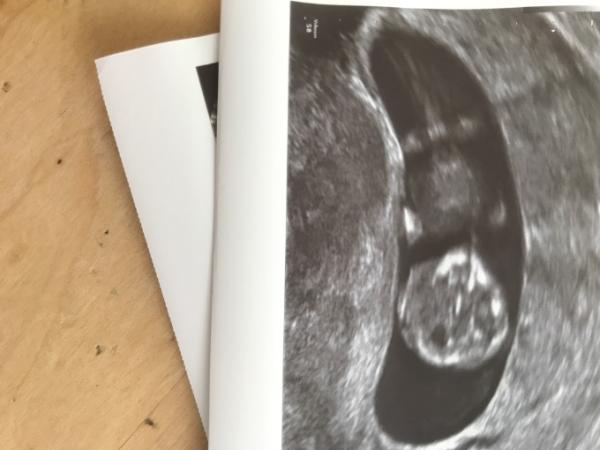 Bild zu Geschlecht erkennen - Baby Forum - Allgemeine Themen