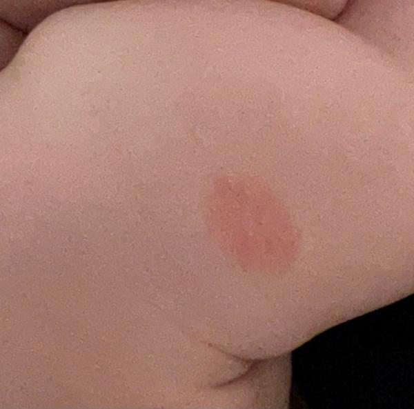 Bild zu Rote Flecken auf dem Körper - Baby Forum - Allgemeine Themen