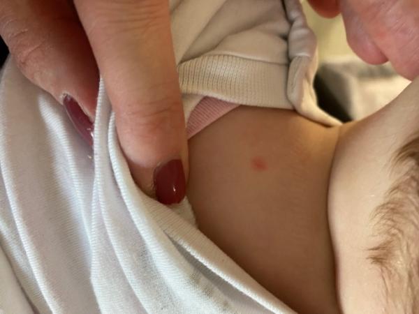 Bild zu Erster Insektenstich 😭 - Baby Forum - Allgemeine Themen